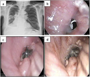 a) Radiografía posteroanterior de tórax en la que se aprecian cambios posquirúrgicos, un hidroneumotórax derecho con un nivel hidroaéreo en la parte más basal del hemitórax derecho y un derrame pleural derecho; b) Visión endoscópica de orificio fistuloso en la zona central del muñón de la bilobectomía inferior derecha; c) Visión endoscópica tras la implantación en el orificio fistuloso de la válvula intrabronquial de 9mm Spiration® Olympus y d) Válvula intrabronquial implantada en el orificio fistuloso tras la instilación de un plasma rico en plaquetas. Nótese el tejido de granulación que existe a su alrededor.
