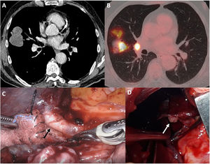 Imagen de TC torácica que muestra una masa hipodensa de bordes lobulados de 6,1×5,8×4,4cm (transverso, anteroposterior, craneocaudal) situada predominantemente en la periferia del lóbulo medio en contacto con la pleura costal, la cisura menor y la cisura mayor. Presenta extensión central condicionando obstrucción con componente endobronquial del bronquio segmentario lateral del lóbulo medio y de bronquios subsegmentarios y adenopatía interlobar medial a la masa de 1,2cm (A). Imagen de PET/TC que muestra una masa hipermetabólica en lóbulo medio con SUVmax 19,51 y captación focal de la FDG en región hiliar derecha, con SUVmax 13,36, en relación con adenopatía (B). Imagen intraoperatoria durante el abordaje robótico en la que se objetiva la presencia de extensión intravascular del tumor a nivel vena de lóbulo medio (flecha) (C). Imagen intraoperatoria durante el abordaje abierto (toracotomía sin sección muscular) en la que se objetiva la presencia de tumor en margen distal (flecha) y clamp en margen proximal de la vena del lóbulo medio tras sección del vaso (D).