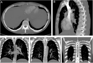 TC de arterias pulmonares. Ventana ósea. Reconstrucción MIP. Corte axial (A), corte sagital (B), cortes coronales (C, D, E). Se observa cuerpo extraño metálico endovascular en ramas subsegmentarias de la arteria pulmonar del lóbulo inferior derecho.