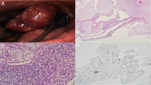 (A) Videothoracoscopic removal of pleuropulmonary tumor from anterior segment of left upper lobe. (B) The tumor displayed long villus-like papillae completely lined by epithelium. Note prominent cartilaginous stromal component H&E, 4×. (C) Dense lymphoplasmacytic infiltrate surrounding and intermingling with cartilaginous stroma. H&E, 20×. (D) Immunostaining for TTF-1 confirmed that villi were lined by respiratory epithelium. Immunohistochemistry, 40×.