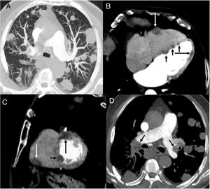 A) Imagen axial de TC de tórax (ventana de parénquima pulmonar), en la que se visualizan múltiples nódulos pulmonares bilaterales. B) y C) Imágenes axial (B) y sagital (C) de TC de tórax (ventana de mediastino), en las que se observan varios nódulos en el espesor miocárdico de la pared libre del ventrículo derecho (flecha blanca), septo interventricular (flechas negras cortas) y pared libre del ventrículo izquierdo (flecha negra larga). D) Imagen axial de TC de tórax (ventana de mediastino), en la que se identifican defectos de repleción en las arterias pulmonares (flechas).