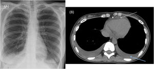 A. Radiografía de tórax AP al ingreso mostrando derrame pleural derecho y pinzamiento del seno costofrénico izquierdo. B. Tomografía axial computarizada torácica mostrando derrame pleural bilateral y derrame pericárdico (la flecha superior indica derrame pericárdico y la derecha, derrame pleural).