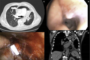 (A) Axial CT scan of the chest showing the path of the bronchopericardial fistula (black arrow) and pneumopericardium (white arrow). (B) Endoscopic image showing the fistula trajectory. (C) Endoscopic view where Watanabe spigot can be seen at the beginning of the fistula trajectory. (D) Coronal CT slice after 48h showing correct positioning of the spigot (arrow).
