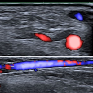 In the upper image, color Doppler ultrasound axial slice of the cephalic vein, showing partial filling in blue, and the radial artery in red. In the lower image, longitudinal section of the cephalic vein.