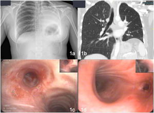 (A) Chest X-ray showing condensation with atelectasis of virtually the entire left lung. (b) Complete occlusion of the lumen with occupation extending to the anterior segmental bronchus, the lingula, and the left lower lobe with secondary atelectasis. (c and d) Mucosal thickening with some nodular appearance partially obstructing the entrance to the left main bronchus preventing passage of the bronchoscope, so lobar bronchi are not visualized.