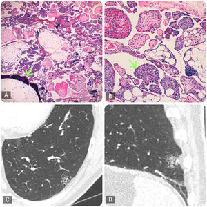 Histología y radiología. A) Microscopía óptica (MO): lesión no encapsulada compuesta de estructuras papilares dentro de espacios quísticos hiperaireados y presencia significativa de tejido adiposo con focos ocasionales de metaplasia ósea (flecha) (H&E 2×). B) MO: en las estructuras papilares (flecha) se observa una proliferación de capilares en el interior y abundantes mastocitos (H&E 10×). C) Corte axial de TC: opacidad en vidrio deslustrado de 19mm en su diámetro máximo, localizada en el lóbulo inferior izquierdo. D) Corte sagital de TC: la lesión asocia un componente sólido, quístico y trabeculado.