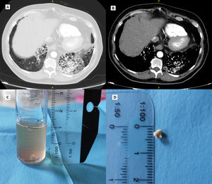 A) Tomografía axial computarizada con ventana de parénquima pulmonar, corte axial. B) Tomografía axial computarizada con ventana mediastínica, corte axial. Se aprecian bronquiectasias cilíndricas de predominio basal bilateral ocupadas por múltiples imágenes hiperdensas en su interior calcificadas compatibles con broncolitos. C) Se observa un cuerpo calcificado, redondeado, de bordes ligeramente irregulares de 4 x 3 mm compatible con broncolito en el tubo de muestra del broncoaspirado. D) Misma pieza en fresco.