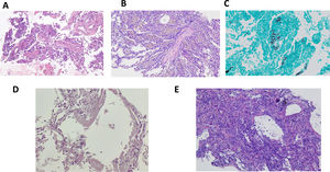 Paciente 4: A) AFOP. Presencia de fibrina en alveolos (H&E, ×200). Paciente 5: B) Neumonía organizada con seudo-pólipo de tejido conectivo en el centro, y la presencia de macrófagos pigmentados en los alveolos adyacentes, correspondientes a hemosiderófagos. Ausencia de reactividad en los neumocitos (H&E, ×100). Paciente 9: C) Presencia de microorganismos con morfología de Pneumocystis jirovecii (tinción de plata metenamina, ×100). Paciente 12: D) Presencia de membranas hialinas en las luces alveolares (H&E, ×100). Paciente 13: E) Se observa daño alveolar difuso en fase proliferativa con engrosamiento intersticial y reactividad neumocitaria (H&E, ×100).