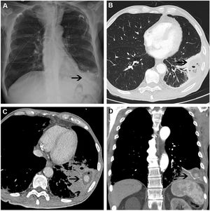 A)La radiografía de tórax muestra la sonda nasogástrica (SNG) con el extremo distal de la misma (flecha) en LII, así como infiltrado alveolar. B)La TC de tórax objetiva en LII un área consolidativa con una imagen hipodensa y burbujas aéreas en su interior (flecha) sugestivas de neumonía necrosante. C,D)Los cortes axial y coronal, respectivamente, de la TC de tórax muestran consolidación cavitada en LII (flecha) con imagen de sangrado activo en su interior.