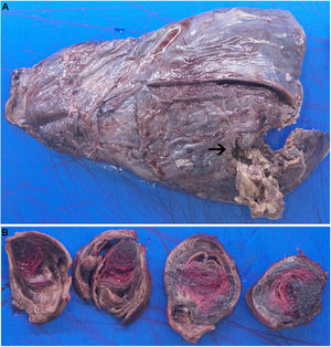 A)La pieza de LII muestra en la porción inferior (flecha) neumonía aguda necrosante abscesificada. B)Los cortes macroscópicos del pseudoaneurisma muestran la pared bronquial con la hemorragia asociada.