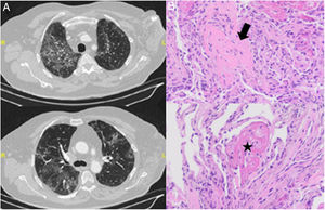 A) Cortes de TC torácica que muestra infiltrados bilaterales en vidrio deslustrado. B) Muestra de biopsia transbronquial con tinción hematoxilina-eosina con presencia de neumonía organizativa en forma de cuerpos de Masson (flecha) junto con agregados («bolas») de fibrina en organización (estrella). Con ausencia de membranas hialinas e hiperplasia de neumocitos tipo 2 y leve infiltrado inflamatorio intersticial.