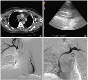 TAC tórax (corte axial, ventana mediastino): conglomerado adeopático paratraqueal derecho con compresión extrínseca de vena cava superior. B. Ecobroncoscopia, análisis con modo Doppler: visualización de conglomerado adenopático con imagen alargada e hiperecoica (stent), sin evidencia de flujo sanguíneo en su interior. C: Cavografía superior: ausencia de paso de contraste a través de stent, compatible con trombosis del mismo. D. Cavografía superior: recanalización completa tras colocación de nueva endoprótesis.