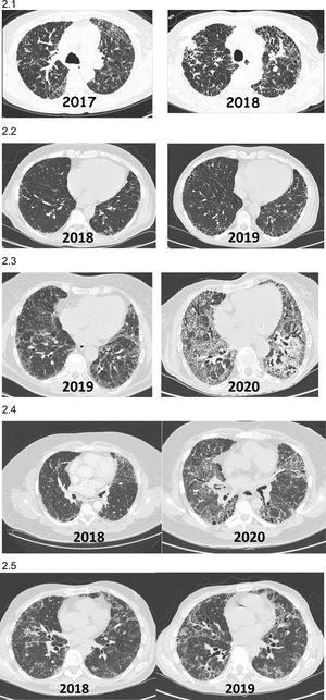 Images (chest HRCT) of patients with non-IPF fibrotic ILD who present PPF during their clinical course. (2.1) Patient with hypersensitivity pneumonitis diagnosed in 2017 who presented a significant progression on HRCT and reduced pulmonary function after 1 year of follow-up. (2.2) Patient with rheumatoid arthritis-ILD (UIP) diagnosed in 2018 in whom 1-year HRCT showed progression of fibrosis with increased respiratory symptoms, despite being in remission from arthritis with methotrexate+abatacept. (2.3) Patient with Sjögren