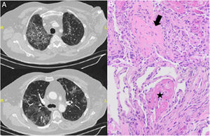 (A) Chest CT slices showing bilateral ground-glass infiltrates. (B) Transbronchial biopsy with hematoxylin–eosin staining showing organizing pneumonia with Masson bodies (arrow) and organizing fibrin aggregates (“balls”) (star). Note the absence of hyaline membranes, and type II pneumocyte hyperplasia and mild interstitial inflammatory infiltrate.