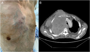 (A) Frontolateral view of the chest with tumor caused by lung mass, showing secondary collateral circulation. (B) Thoracic CT slice with extensive infiltrating mass.