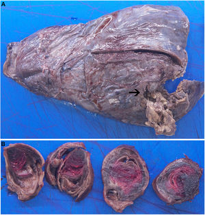 (A) Left lower lung specimen showing acute necrotizing pneumonia with abscess in the lower part (arrow). (B) Macroscopic slices of the pseudoaneurysm showing the bronchial wall with associated bleeding.