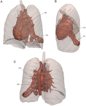 Volumetric reconstruction of contrast-enhanced lung CT angiogram. Left pulmonary artery (LPA) arteriovenous malformation with a maximum caliber of 17mm and arterial branches draining to the left lower pulmonary vein (LPV) with a maximum proximal caliber of 19mm. Two 2 vascular sacs connected by pulmonary arterial and venous branches of 35mm×28mm and a medial sac of 27mm×20mm were also identified. (A) Left anterolateral view. (B) Left laterosuperior view. (C) Posterior view.
