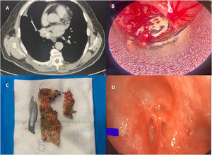 (A) Computed axial tomography. (B) Bronchoscopy findings. (C) Extracted foreign material. (D) Post-operative follow-up.