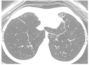 Baseline chest computed tomography slice.