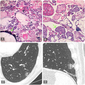 Histology and radiology. (A) Optical microscopy (OM): non-encapsulated lesion composed of papillary structures within hyperaerated cystic spaces and significant presence of adipose tissue with occasional foci of bone metaplasia (arrow) (H&E 2×). (B) OM: a proliferation of capillaries is seen in the interior of papillary structures (arrow) along with abundant mast cells (H&E 10×). (C) CT axial slice: ground glass opacity measuring 19mm in its maximum diameter, located in the left lower lobe. (D) CT sagittal slice: the lesion combines a solid, cystic, and trabeculated component.