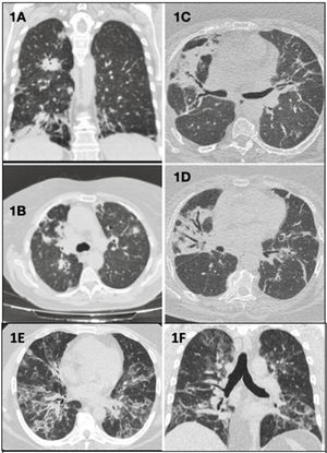 Plano coronal (A) y plano axial (B): consolidaciones parenquimatosas bilaterales con distribución peribroncovascular, periférica y subpleural. Planos axiales (C y D): opacidades atelectásicas-fibróticas bilaterales de distribución peribroncovascular, con bronquiectasias y bronquielectasias de tracción. Plano axial (E) y plano coronal (F): opacidades alvéolo-intersticiales con distribución bilateral y peribroncovasculares que coexisten con otras de localización periféricas en vidrio deslustrado y de aspecto en bandas.
