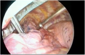Detección de nódulo pulmonar marcado con MAATC99 mediante sonda portátil.