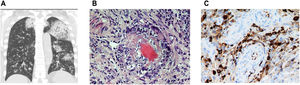 A. TAC torácico con cortes coronales con presencia de opacidades bilaterales asociadas con hemorragia alveolar. Modificada. B. Biopsia nasal con afectación de la pared vascular con presencia de vasculitis. C. Tinción inmunohistoquímica específica positiva para IgG4 (25 células plasmáticas IgG4 + por campo de gran aumento) junto al infiltrado linfoplasmocítico e histiocitos. Presencia de congestión vascular.