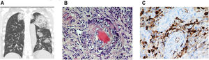 (a) Chest CT with coronal slices showing bilateral opacities associated with alveolar hemorrhage. Modified. (b) Nasal biopsy with vascular wall involvement showing vasculitis. (c) Specific immunohistochemical staining positive for IgG4 (25 IgG4-positive plasma cells per high power field) together with lymphoplasmocytic infiltrate and vascular congestion (c). Presence of vascular congestion.