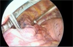 Detection of MAATC99-labeled pulmonary nodule by hand-held probe.