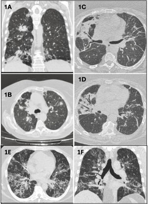 (A) (Coronal plane) and (B) (axial plane): bilateral parenchymal consolidations with peribronchovascular, peripheral, and subpleural distribution. (C and D) (Axial planes): bilateral peribronchovascular opacities due to atelectasis and fibrosis, and bronchiectasis and traction bronchiectasis. (E) (Axial plane) and (F) (coronal plane): alveolo-interstitial opacities with bilateral and peribronchovascular distribution that coexist with other peripheral band-like ground glass opacities.