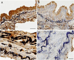 Immunolocalization of EC-SOD in airway and vascular walls of COPD patients and control subjects. Presence of EC-SOD was markedly higher in airways (A, bar=25μm) and vascular walls (C, bar=10μm) of controls subjects when compared to those of COPD patients (B, bar=25μm, and D, bar=25μm, respectively).