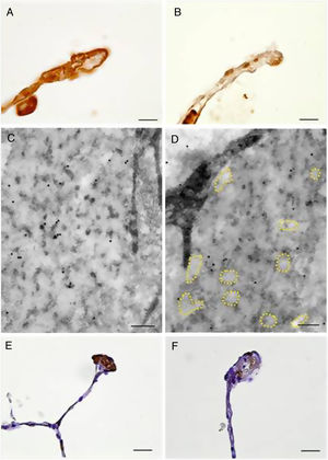 Immunolocalization of EC-SOD and fibulin-5 in alveolar walls of COPD patients and control subjects. Alveolar walls of control subjects showed increased presence of EC-SOD (A, bar=10μm) and fibulin-5 (E, bar=20μm) as compared to those of COPD patients (B, bar=10μm, and F, bar=20μm, respectively). (C) and (D) Electron microscopy of immunolocalised EC-SOD in elastic fibres from alveolar walls of a control subject (C, bar=200nm) and a COPD patient (D, bar=200nm). Colloidal gold labelling indicating EC-SOD immunolocalization was mostly absent in the fibrillary component alveolar elastic fibres of COPD samples. Dashed lines indicate loss of fibrillary component.
