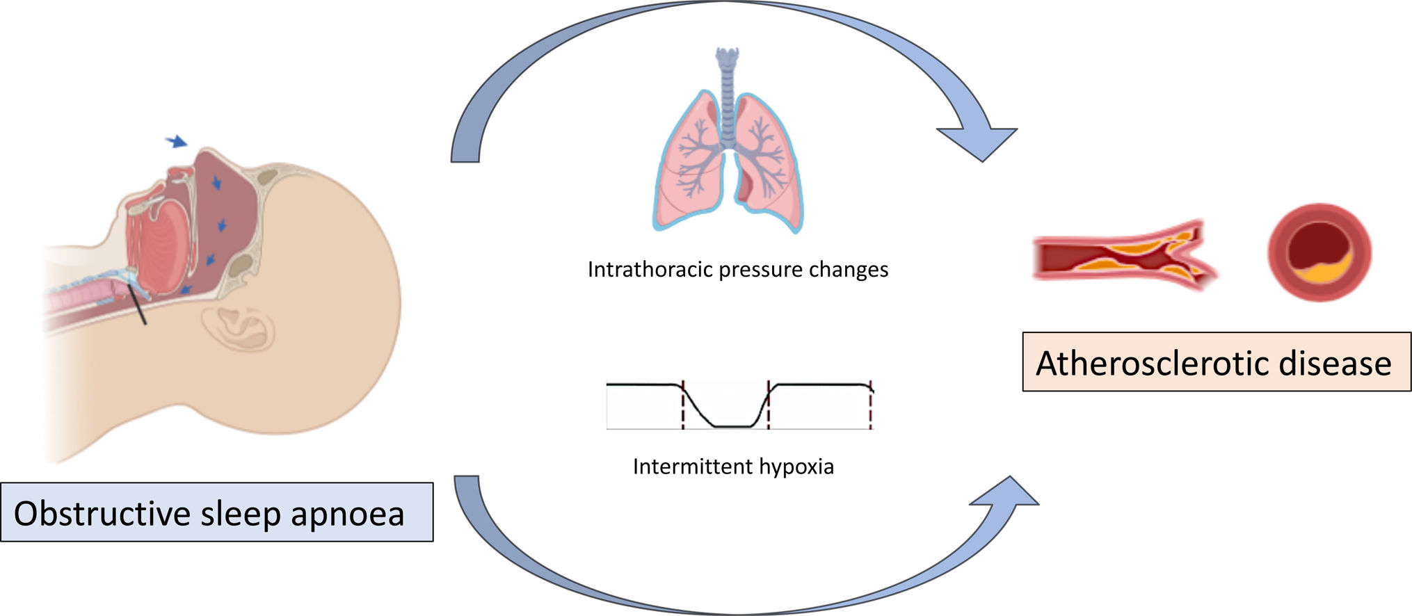 Prevalence of Obstructive Sleep Apnoea and Its Association With ...