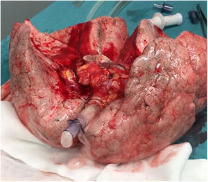 Lungs of case 1 after evaluation by ex vivo lung perfusion. As assessed by EVLP, after 60min of full-flow perfusion, the lung could not collapse without ventilation and developed expectoration of copious amounts of pink frothy sputum.