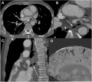 (A and B) Contrast-enhanced axial chest computed tomography images obtained with the mediastinal window setting, showing (A) a filling defect inside the left atrium (arrow) compatible with a thrombus and associated with gaseous foci, and (B) an air trajectory compatible with a fistula (arrow) communicating with the esophagus, located to the right of the spine (arrowhead) and the ostium of the left inferior pulmonary vein. In C, oblique reconstruction highlights the anteroposterior fistulous tract (arrow) between the esophagus and left atrium. In D, sagittal minimum-intensity projection reconstruction of an image of the brain reveals signs of leptomeningeal gas embolism.