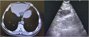 CT scan and EBUS-b-FNA: In right para-aortic location, it was observed a nodular area with 17mm short axis described as adenopathy, that was punctured throught echoendoscopy.