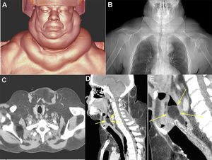 In A, chest computed tomography image obtained with three-dimensional coronal reconstruction showing the appearance of the patient