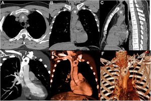 Non-enhanced chest CT (A–C) showed a prevascular mediastinal mass (asterisks). Enhanced CT with coronal reconstruction (D, E) and 3D volumetric reconstruction (F) demonstrated a fusiform aneurysm of the brachiocephalic vein, beginning 1.5cm distal to the internal jugular vein and extending to the superior vena cava (asterisks).