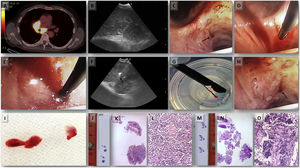 Case 4 (A) PET/CT showing increased FDG uptake in the sub-carinal (7) and right hilar stations. (B) EBUS-TBNA was performed with a 22-gauge needle (EchoTip ProCore: Cook Medical) in station 7 node. (C) Puncture site made by TBNA needle; steps of inserting 1.1mm cryo-probe through the puncture site, (D) tip of the cryo-probe approaching the puncture site, (E) after pushing the probe gently the tip of the cryo-probe is completely inside the node. (F) EBUS image showing the tip of the 1.1mm cryo-probe within the lymph node. (G) Pentax EBUS scope (EB-1970UK) with 1.1mm cryo-probe in the working channel. The tip of the probe has the lymph node tissue obtained by cryobiopsy. (H) Bronchoscopic view of the puncture site after taking cryo-nodal biopsy (no bleeding was observed). (I) Samples obtained from transbronchial mediastinal cryobiopsy. (J) Simple view of cryobiopsy stained with H&E. (K) Microscopic image of the cryobiopsy sample at low magnification (2×) showing an integrated and compact tissue. (L) Microscopic image of cryobiopsy (10×) showing a well-preserved architecture. (M) Simple view of the cell-block obtained by TBNA stained with H&E. (N) Microscopic image (2×) of the biopsy obtained by TBNA where a very fragmented tissue is observed. (O) Microscopic image (10×) of TBNA cell-block with marked artifacts of size, shape, and chromatin density.