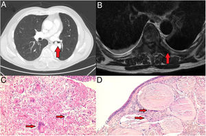 (A) 10.5mm×11mm endobronchial nodular lesion located in the left main bronchus. (B) Hyperinflating lytic lesion in the D7 vertebra, with partial infiltration of its posterior elements and edema of the adjacent prevertebral soft tissues. (C) Soft tissue biopsy (×20): multinucleated giant cells (red arrows) loosely distributed along with numerous mononuclear cells in a fibrous background (×20 magnification). (D) Bronchial mucosa (×10): atypical cell proliferation located at the level of the submucosa composed of soft-looking mononuclear cells, multinucleated giant cells (red arrow) and formation of metaplastic bone tissue (red arrow).