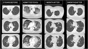 Evolution of radiological lesions in CT, before, during and after SARSCOVID 2 bilateral pneumonia.
