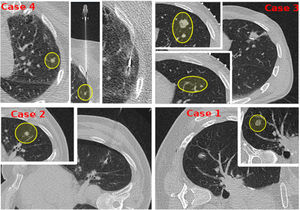 Clinical cases: non-palpable and small pulmonary lesions.