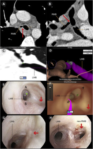 Axial (Panel A) and coronal (Panel B) reconstruction of CT thorax showing RMB was occluded by a web-like structure (red arrow) with patent distal airways. The actual location of RMB ostium marked on VBN platform as a target (green dot) in Panel C and D. Correlation of bronchoscopic (Panel E) and virtual bronchoscopic images (Panel F) showing the postulated site of RMB ostium based on best-guess strategy (red arrow) and the actual site by virtual bronchoscopic navigation (green dot). The actual location of right main bronchus ostium identified by virtual bronchoscopic navigation pre-procedure showing subtle mucosal puckering with converging fibrotic bands (Panel G) and four months later which shown patent neo-RMB with minimal granulation tissue (Panel H).