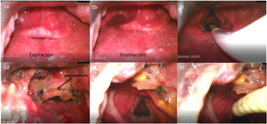 C-MAC videolaryngoscopic view in spontaneous breathing showing a floppy epiglottis preventing visualization of the glottis ((a) inspiration and (b) expiration). The epiglottis was lifted with the videolaryngoscope blade, allowing full visualization of the glottis. In spontaneous breathing, a flexible-tipped bougie was inserted and OTI could be performed (c). After the epiglottectomy, laryngoscopy showed how the remaining epiglottis prevented visualization and prolapsed slightly toward the glottis on inspiration (d). The epiglottectomy area was lifted with the videolaryngoscope blade, permitting the visualization of the glottis (e), and a flexible-tipped bougie was inserted through the glottis for patient intubation (f).