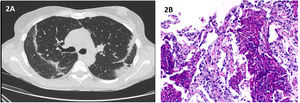 (A) Chest HRCT: peripheral and subpleural areas of linear parenchymal densification; (B) Histopathological findings of transthoracic needle biopsy: Besides the “eosinophilic microabscesses” there is also more evident alveolar thickening, edema and foci of fibrosis. (Original magnification: 100×).