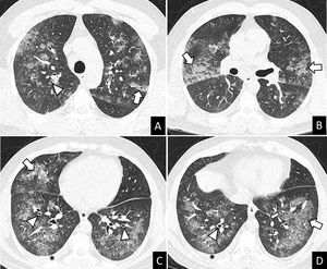 Unenhanced chest-CT. (A–D) Axial views. The CT scan showed bilateral ground glass opacities (GGO) and consolidation with smooth interlobular septal thickening (arrows), peribronchial cuffing (arrowheads), and mild bilateral pleural effusion (asterisks).
