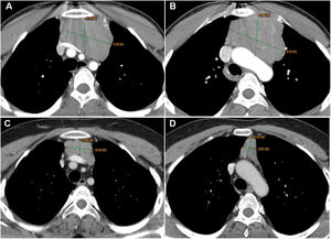 Axial sections CT of the thorax, with mediastinal window show thymoma with the anterior mediastinal location (A, B). After one month of myasthenia gravis treatment, serious regression is seen in thymoma (C, D).
