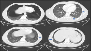 Bilateral significant pneumothorax and bilateral lung metastases.