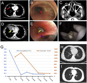 Chest imaging showed hyperattenuated mucoid impaction in the right middle lobe (A). Bronchoscopy showed chronic inflammation (B). Paranasal sinus CT image with negative result (C). Chest CT reexamination images showed the consolidation in the right middle lobe (D). Bronchoscopy showed a yellow mucous plugs, in the right middle lobe (E) and complete removed by cryotherapy under bronchoscopy (F). Eosinophils count and total serum IgE level (G). Chest CT 2 weeks after treatment with VRCZ (H). Chest CT 6 months after treatment with VRCZ (I).