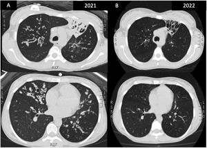 (A) HRCT prior to initiation of treatment: complete atelectasis of the LSI and lingula with beaded and cystic bronchiectasis with severe bronchial thickening. (B) Control HRCT after 18 months of treatment: resolution of mucosal impactions, bronchial thickening and resolution of complete atelectasis in LSI, with beaded bronchiectasis without being occupied by secretions.